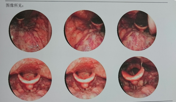 主任为何先生检查,经德国wolf内窥镜显示下,他的喉部黏膜慢性充血,喉